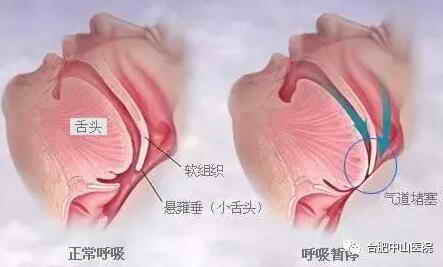 肥胖打鼾關(guān)系 肥胖打鼾原因